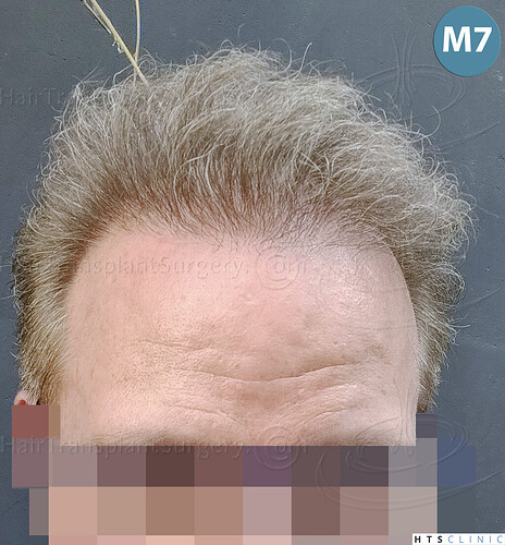 Dr. Jean Devroye, HTS Clinic / 6494 FUE-BHT (3150 + 3344) / NW VII, 2 sessions photo