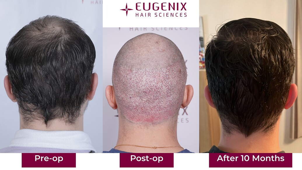 https://cdn.forumhairtransplant.com/optimized/3X/4/a/4af0ed1a5b7bcc6e6417b62ea5f133d453ad5642_2_1035x582.jpeg