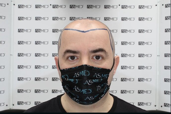 ASMED CLINIC - DR.KORAY - 5060 GRAFTS FUE photo