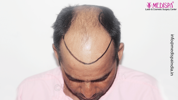 Dr. Suneet Soni - 4992 Grafts | 12-Month Result | Combination FUT + FUE + Beard photo
