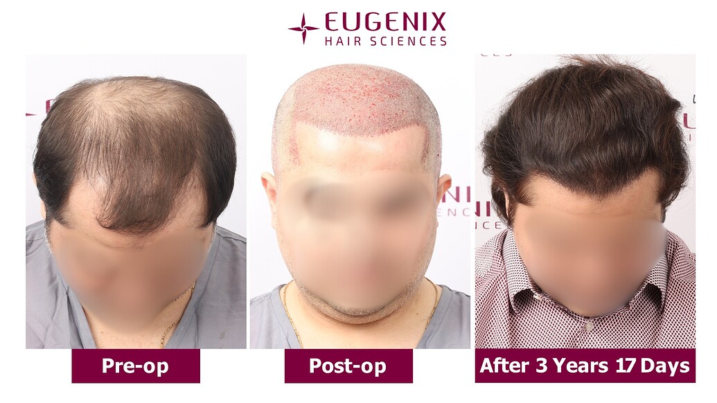 https://cdn.forumhairtransplant.com/optimized/3X/4/b/4b387b04650d2a83b3178f4bcde3a3c0a375ce10_2_1035x582.jpeg