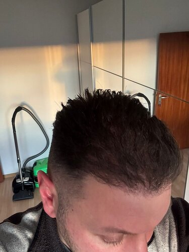 Ozlem Bicer MD-Hair Transplant-2910 Grafts FUE by micro-motor, 7. months result photo