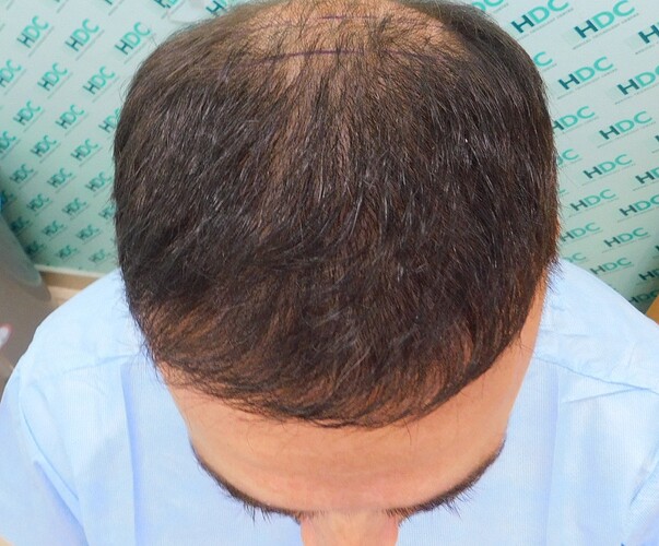 Two FUE Surgeries Totaling 6560 Grafts – HDC Hair Clinic photo