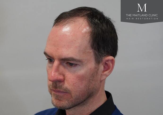 Dr Ball - The Maitland Clinic 1432 Grafts By FUE photo