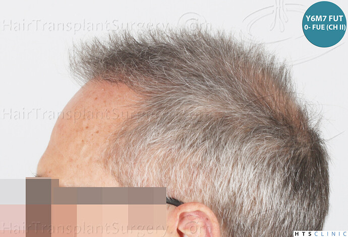 Dr Devroye + Dr Montesanti + Dr Jenard / 7015 grafts (4512 FUT + 2503 FUE) / 2 sessions photo