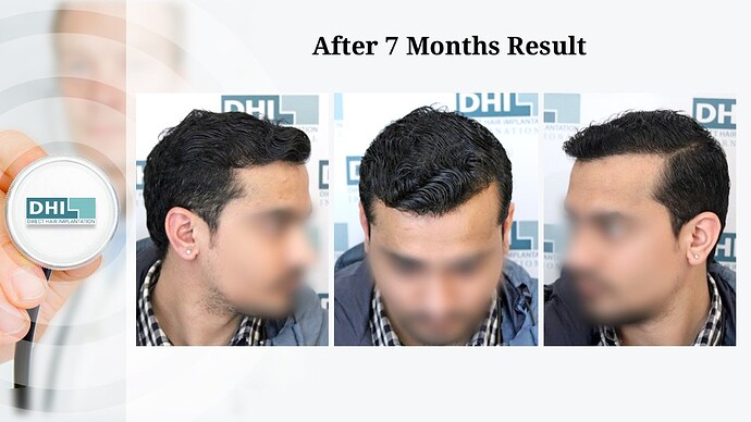 DHI India | NW 2 | 1,359 Grafts | 7-Months DHI Hair Transplant Results photo