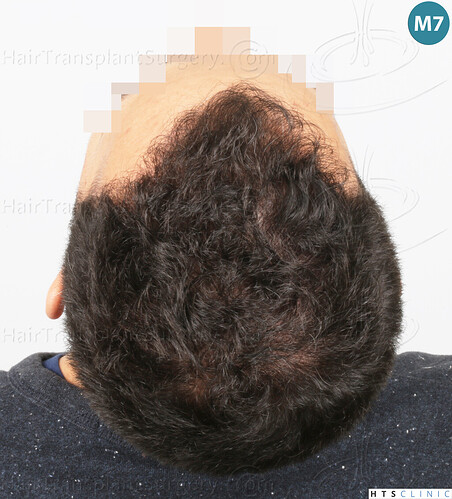 Dr Devroye + Dr Montesanti + Dr Jenard, HTS Clinic / 2018 FUE / Hairline & frontal area photo