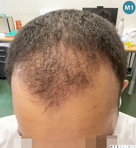 Dr Devroye + Dr Montesanti + Dr Jenard, HTS Clinic / 2018 FUE / Hairline & frontal area photo