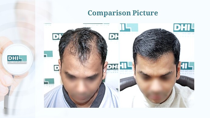 DHI India™ | NW 5 | 3,257 Grafts | 7 Months Hair Transplant Result photo
