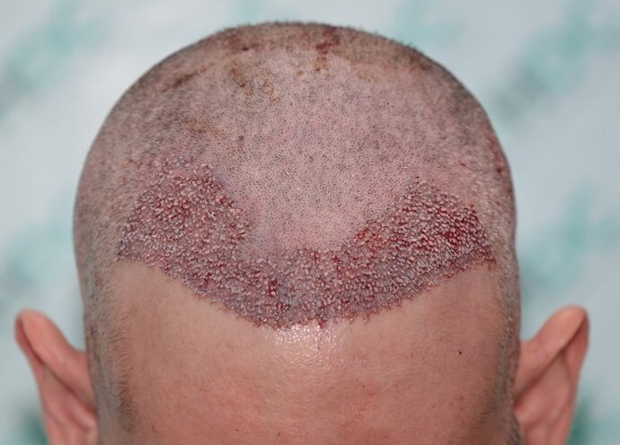 Result of Class 3V Patient – 3530 Grafts – HDC Hair clinic – Dr Maras photo