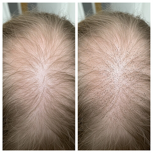 Comparison of thinning hair before and after scalp micropigmentation for density