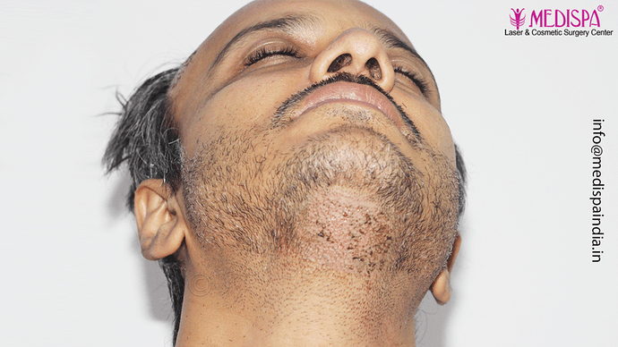 Dr. Suneet Soni - 4889 Grafts | 2.5 Years Result | Combination FUT + FUE + Beard photo