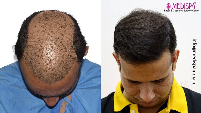 Dr. Suneet Soni - 4500 Grafts, Combine FUT + FUE Technique, NW-III photo