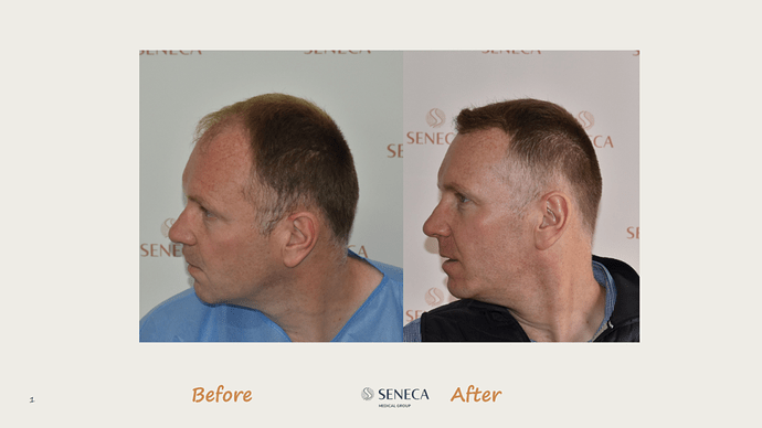 Seneca Medical Group - 3189 grafts with Direct Fue photo