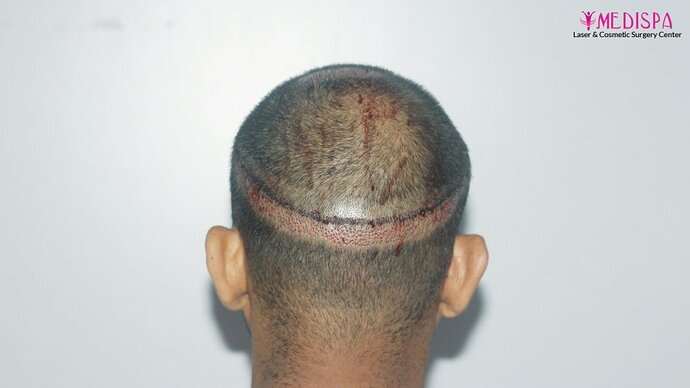 Dr. Suneet Soni - 4025 Grafts | 12-Month Result | Combination FUT + FUE photo