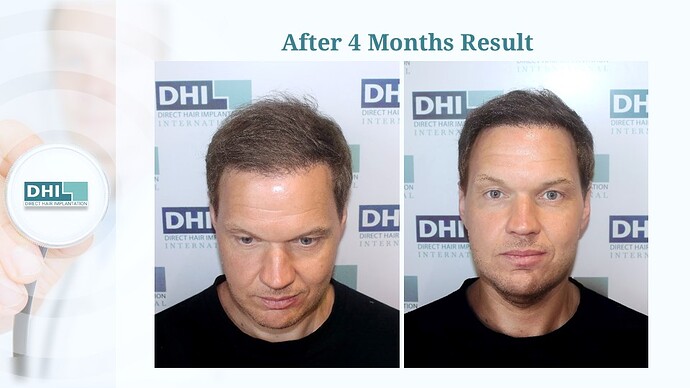 DHI India™ | NW 6 | 2,507 Grafts | 4 Months Hair Transplant Results photo