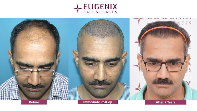 hair-transplant-before-after-8