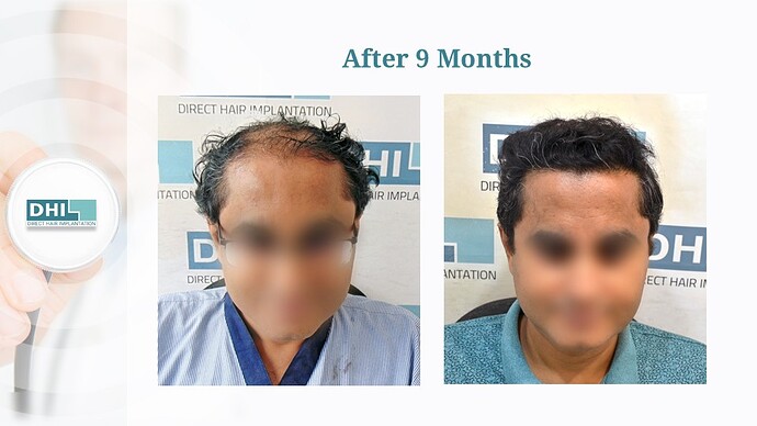 DHI India | NW Scale 6 | 4,127 Grafts | 9 Months DHI Hair Transplant Result photo