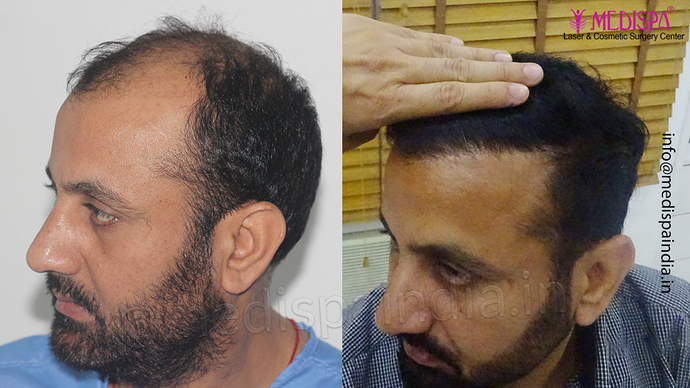 Dr. Suneet Soni - 5334 Grafts, Combine FUT + FUE + BHT (Beard) Technique, NW- V photo