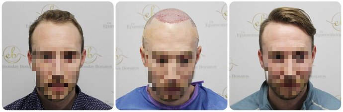 Dr Bonaros, Glasgow, UK / 1819 FUE grafts / 0-12 Months photo