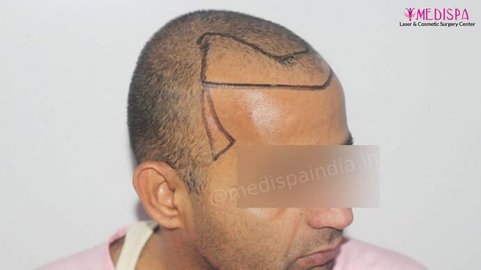 Dr. Suneet Soni - 4025 Grafts | 12-Month Result | Combination FUT + FUE photo