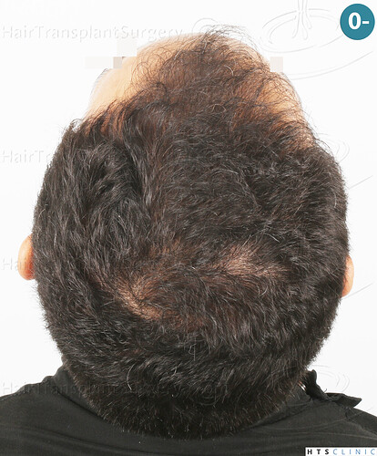 Dr Devroye + Dr Montesanti + Dr Jenard, HTS Clinic / 2018 FUE / Hairline & frontal area photo