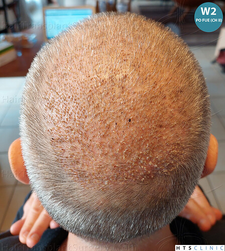 Dr Devroye + Dr Montesanti + Dr Jenard / 7015 grafts (4512 FUT + 2503 FUE) / 2 sessions photo