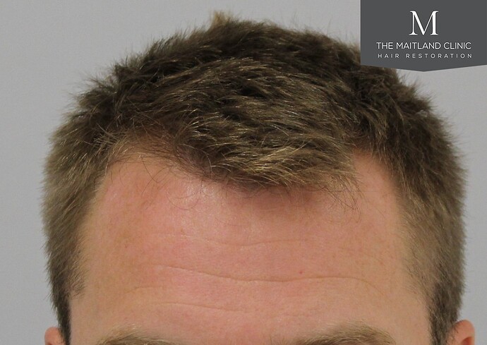 Dr Ball - The Maitland Clinic 1204 Grafts By FUE photo