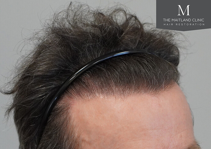 Before and after results: 1694 grafts by FUE at The Maitland Clinic (Dr Edward Maitland Ball) photo