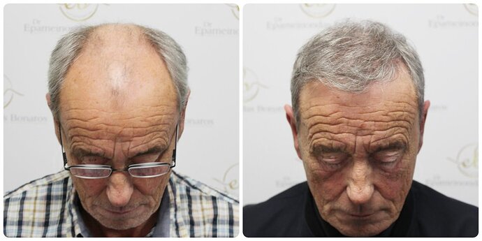 Dr Bonaros, Glasgow, UK / 3524 FUE grafts / 0-12 Months photo