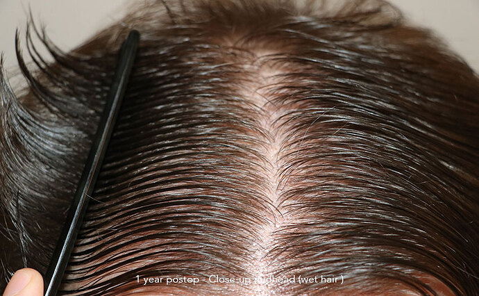 Case performed by Dr. Feriduni – 3322 FU in 1 procedure photo