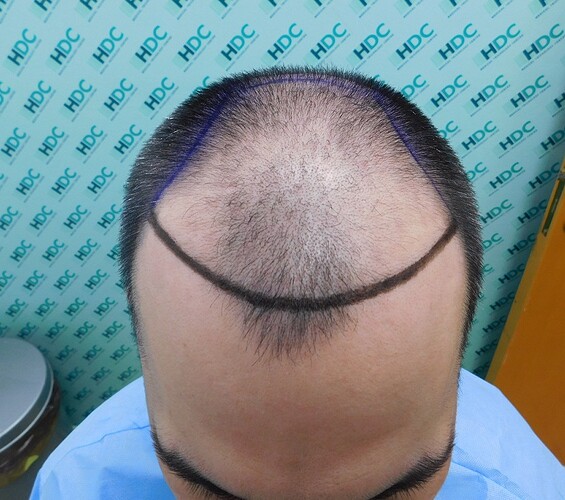 FUE Result for 4400 Grafts – 6 Months after – HDC Hair Clinic photo