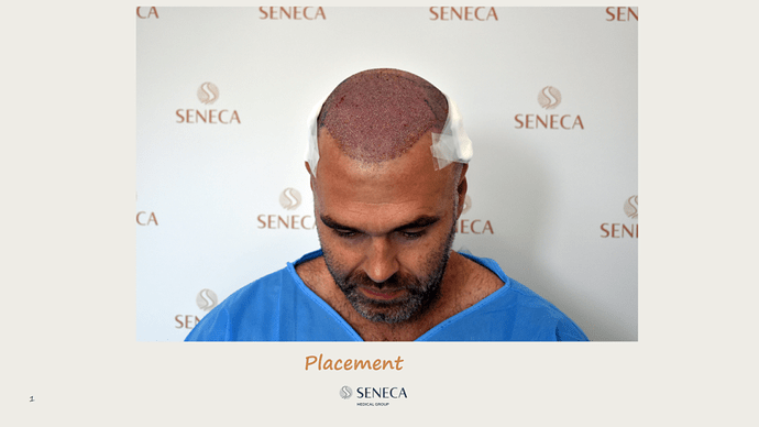 Seneca Medical Group - 2300 grafts with Direct Fue photo