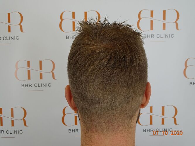 Dr.Bisanga, BHR Clinic Brussels 3251 FUE 0 - 8 Months photo