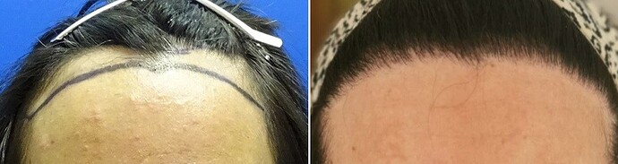 Dr. Bisanga, BHR Clinic, 2000 FUE / 0-8 Months - Female Case photo