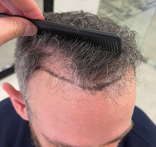 Result of Class 3V Patient – 3530 Grafts – HDC Hair clinic – Dr Maras photo