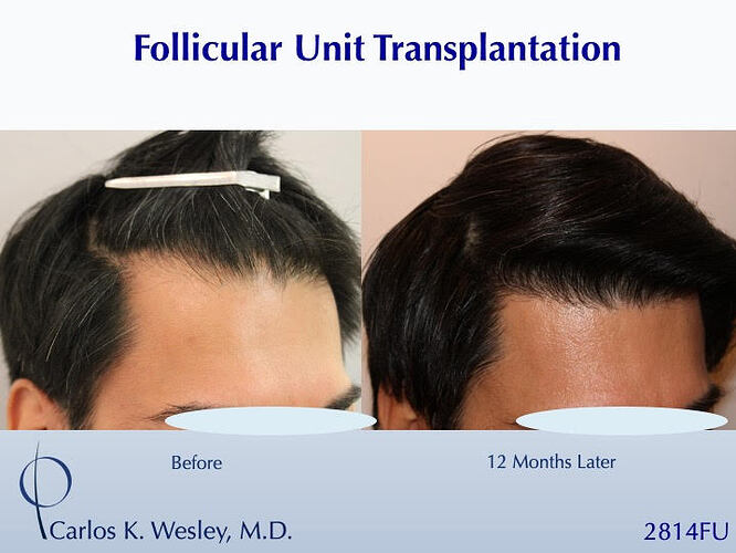 #BAM Stronger, Healthier Hairline (2814 FUT grafts): Carlos K. Wesley, M.D. (NYC & LA) photo