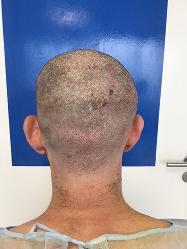 Dr. Bisanga & Dr. Kostis BHR Clinic - 3500 FUE 0 - 8 Months photo