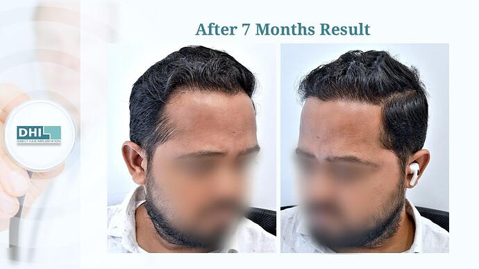 DHI India™ | NW 3 | 3,506 Grafts | 7 Months Hair Transplant photo