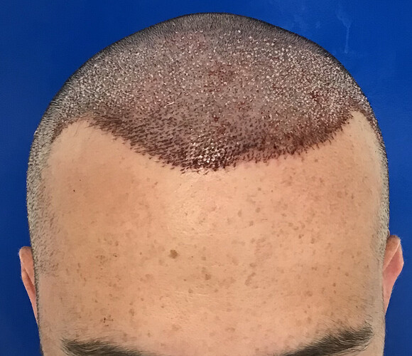 Dr.Bisanga + Dr.Kostis, 2980 FUE 0 - 5 MONTHS..SUPER FAST AND DENSE GROWTH!! photo