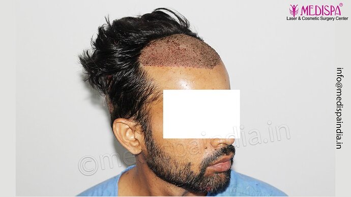 Dr. Suneet Soni - 3029 FUE Grafts, FUE Method (Trivellini System), NW - III photo