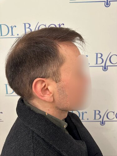 Ozlem Bicer MD-Hair Transplant-3980 Grafts FUE by micro-motor, 12. months result photo