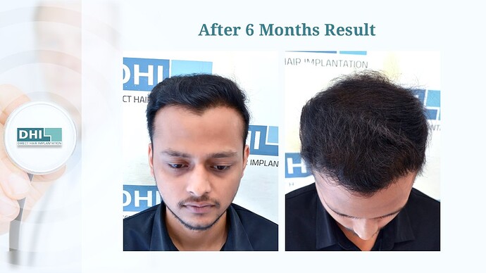 DHI India™ | NW 4 | 4,265 Grafts | 6-Months DHI™ Hair Transplant Results photo