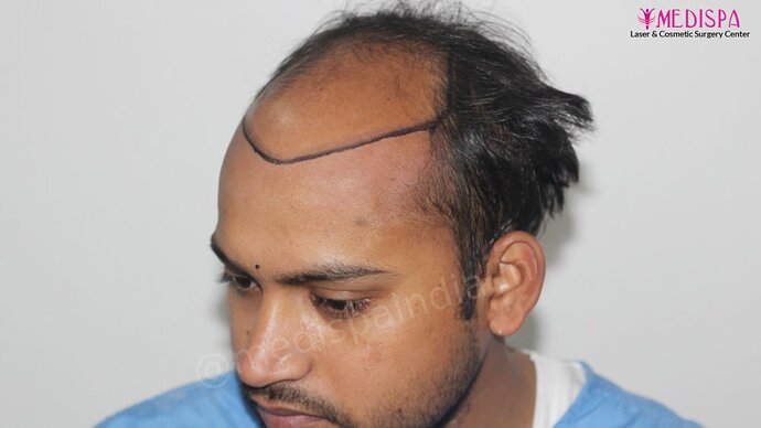 Dr. Suneet Soni - 5587 Grafts, Combine FUT + FUE + Beard Technique, NW : V-VI photo