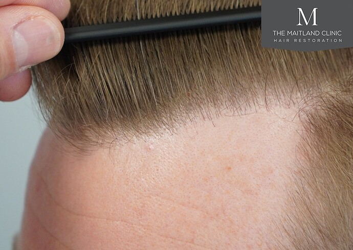 Dr Ball - The Maitland Clinic 1204 Grafts By FUE photo