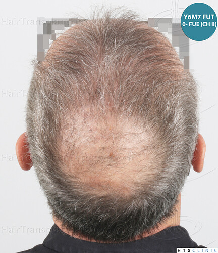 Dr Devroye + Dr Montesanti + Dr Jenard / 7015 grafts (4512 FUT + 2503 FUE) / 2 sessions photo