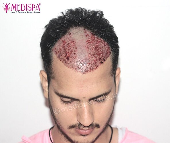 Dr. Suneet Soni - 2500 FUE Grafts, NW- III photo