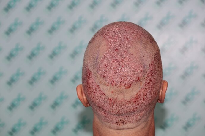 Hair Transplant Outcome with 4000 Grafts Across NW5 Zone – HDC Hair Clinic photo