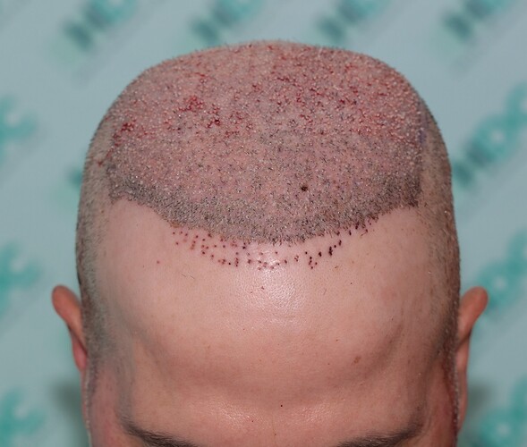 Major Repair of Mini Grafts - Result: 4160 Grafts – HDC Hair Clinic photo