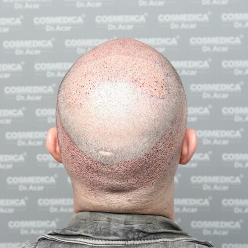 Cosmedica - 4000 Graft FUE Hair Transplant with Sapphire Blades. photo